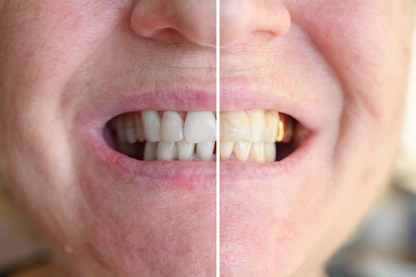 Smile Makeover Treatment For A Missing Tooth
